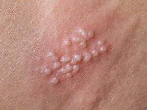 آیا HPV با یک‌ بار سکس منتقل می‌شود+ابتلا به ویروس HPV+ازمایش خون وHPV