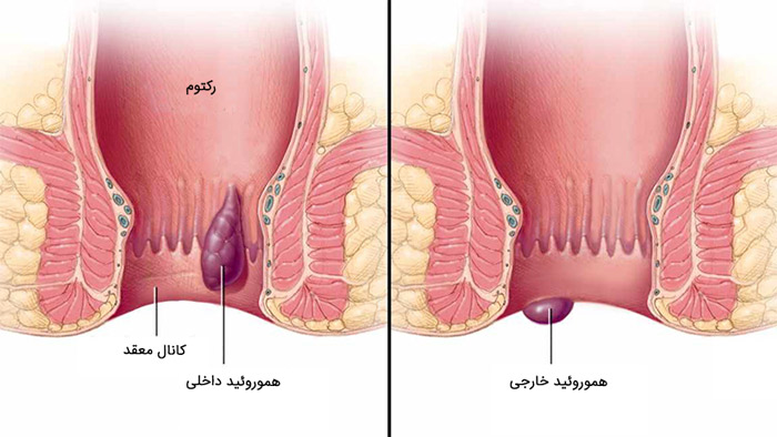 آیا رابطه مقعدی باعث زگیل تناسلی میشود؟